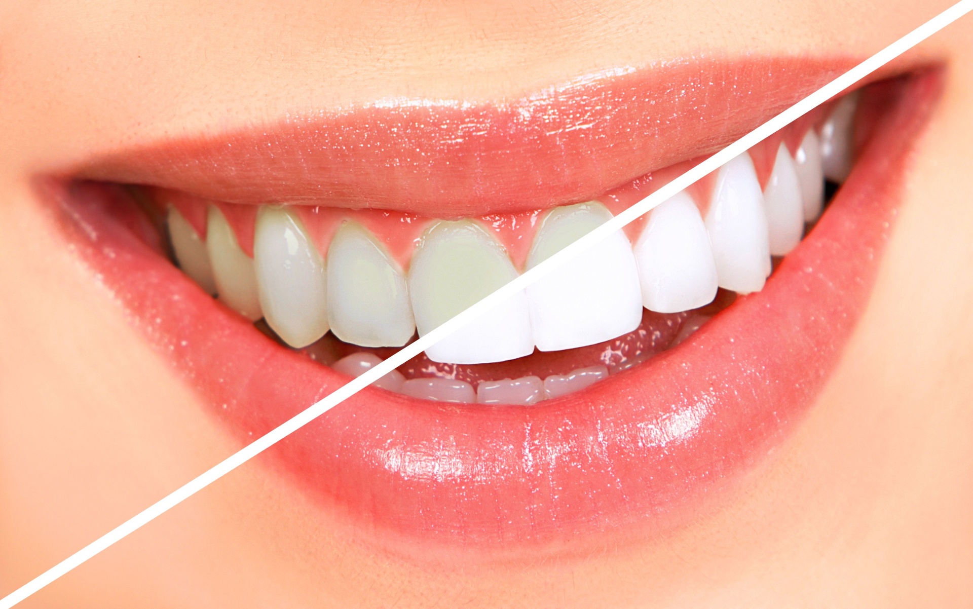 Bright natural smile showing professional teeth whitening results